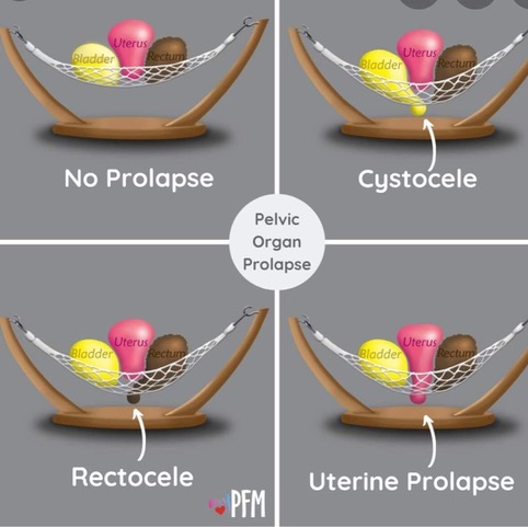 Pelvic Organ Prolapse